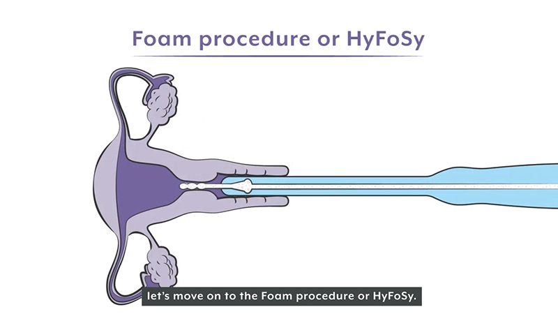 Making a Sensitive Fertility Procedure Easier for Patients to Understand 1 ExEm Women’s Health - Patient Education